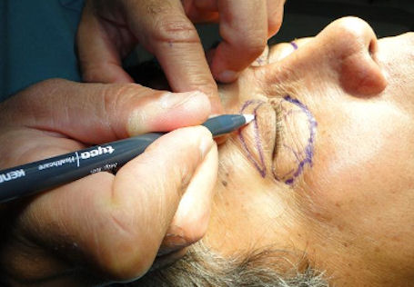 blefaroplastia inferior