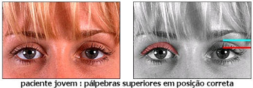 blefaroplastia
