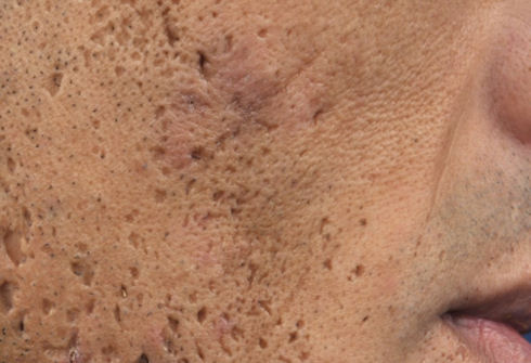 cicatriz acne
