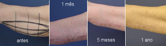 cicatriz cirurgia