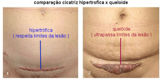cicatrizes