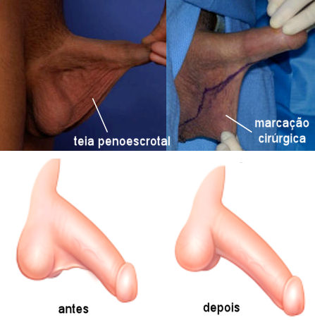 cirurgia aumento peniano