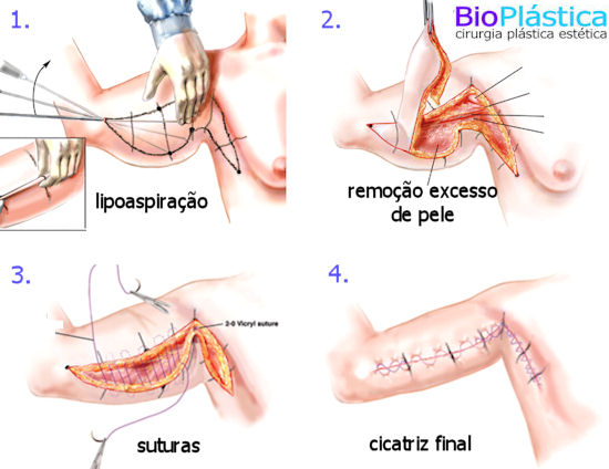 cirurgia de braço