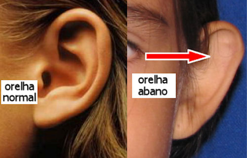 cirurgia de otoplastia