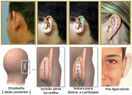 cirurgia otoplastia