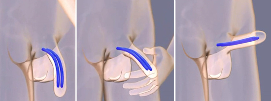 cirurgia protese peniana