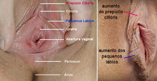 cirurgia vagina