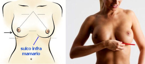 mastopexia para levantar seios