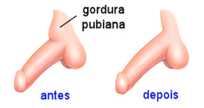 lipoaspiração pubiana