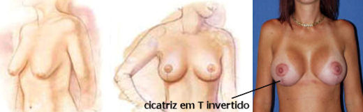mastopexia