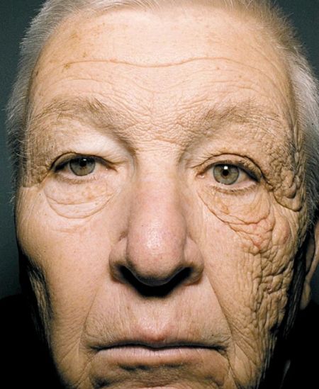 peeling fenol