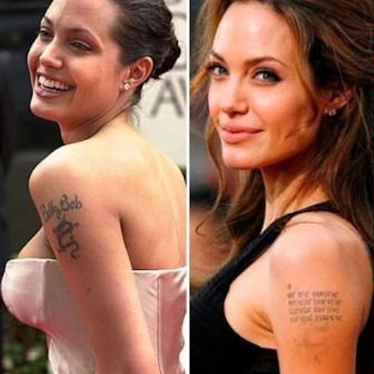 remoção de tatuagem laser