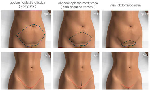 tipos plastica de barriga