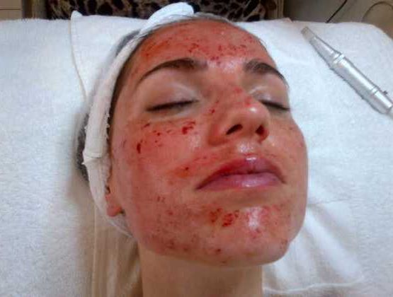 tratamento cicatrizes de acne