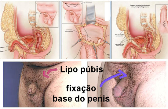 lipoaspiração do pubis e pexia do penis