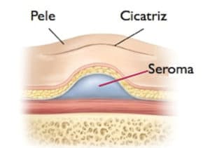 seroma