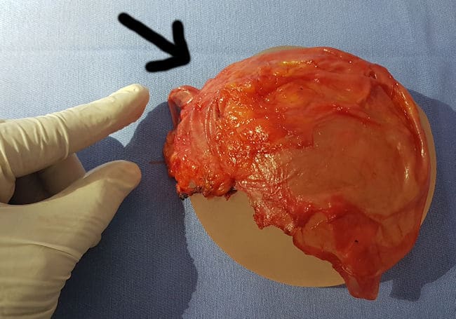 contratura capsular protese de silicone